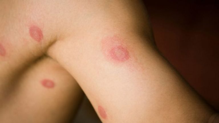 Jenis Jenis Infeksi Jamur Kulit Ringworm